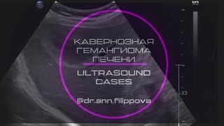 КАВЕРНОЗНАЯ ГЕМАНГИОМА ПЕЧЕНИ. Ультразвуковая диагностика. Сavernous liver hemangioma. ULTRASOUND.