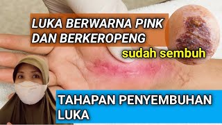 KAPAN  LUKA KAMU DI KATAKAN SEMBUH- FASE PENYEMBUHAN LUKA