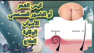 كيس الشعر،الأسباب، العلاج، الوقاية