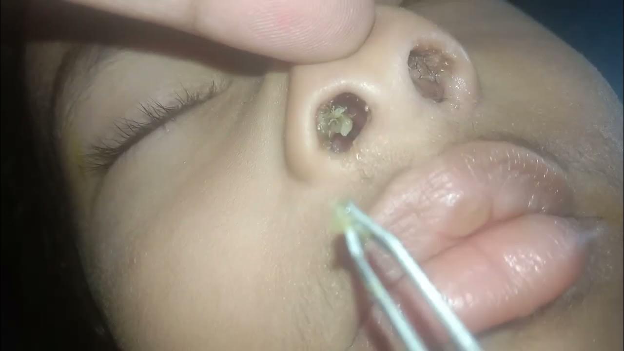 How To Clear Nose And Ear Congestion
