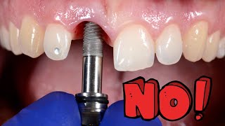 The Top Reasons You Should NOT Get Dental Implants - Expert Advice