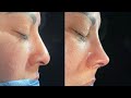 Rinoplastia Dr Jaimes 14/09/24