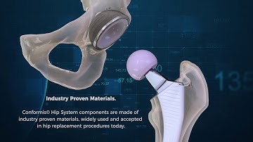Conformis Hip Animation