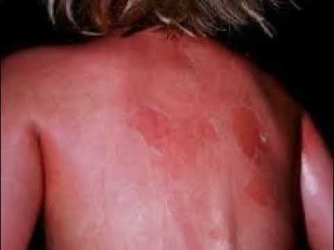 Videó: Vészhelyzet a leforrázott bőr szindróma?