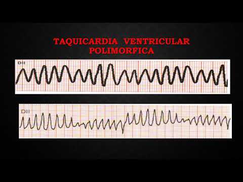 Vídeo: Taquicardia Ventricular