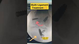 3 Broken Ligament Treatment 🔥 एक साथ चार लिगामेंट टूटे 💥#ligament #ligamentinjury #ligamenttear#bone