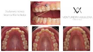 Distalamiento Secuencial  Invisalign con Minitornillo. Sequential Invisalign Distalization Miniscrew