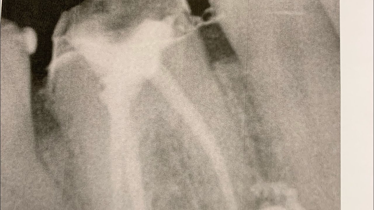 MY FIRST AND LAST TOOTH ROOT CANAL ..PROMISE IT HURT AFTER THE