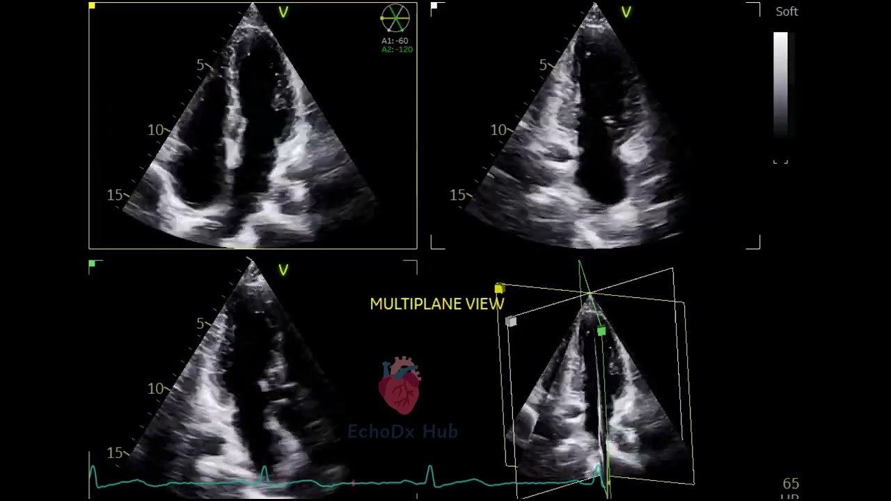 🫀 2D Echo – Apical Multiplane View 