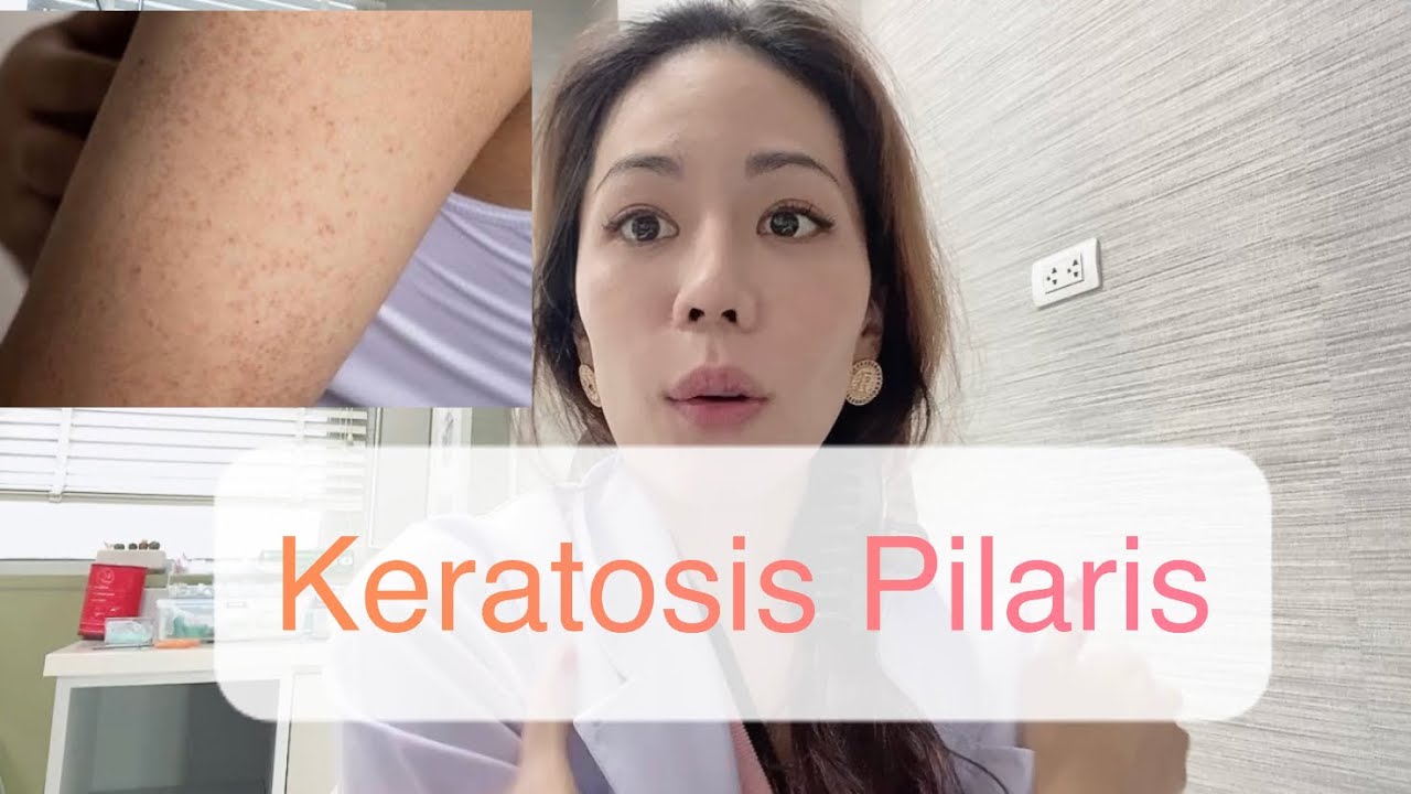 ผิวสากต้นแขนเป็นจุดๆ (Keratosis Pilaris) EP.146 YouTube