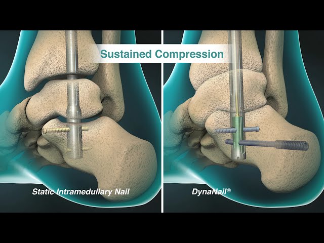 b. — Post-operative radiographs of the patient shown in figure 3a. The... |  Download Scientific Diagram