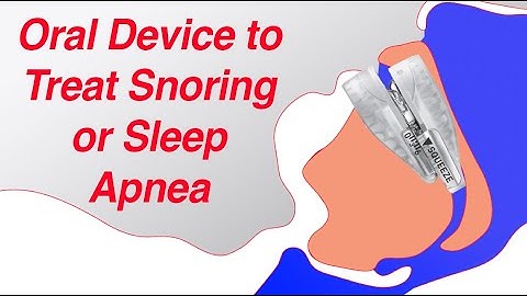 Mandibular Advancement Device (MAD) to Treat Snoring and Sleep Apnea