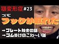 【顎変形症 #23】ついにフックが取れた！ゴムかけのこわ～い話＆プレート除去の話【保険適用/保険治療】