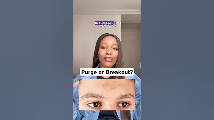 Purging or breakout? Here’s how to tell the difference #skinpurging #acnehelp #acne #shorts
