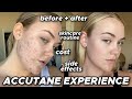accutane experience | before & after, side effects, cost, skincare routine
