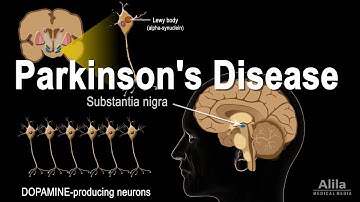 Parkinson