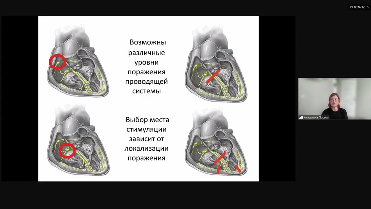 Электрокардиостимуляция: основы программирования