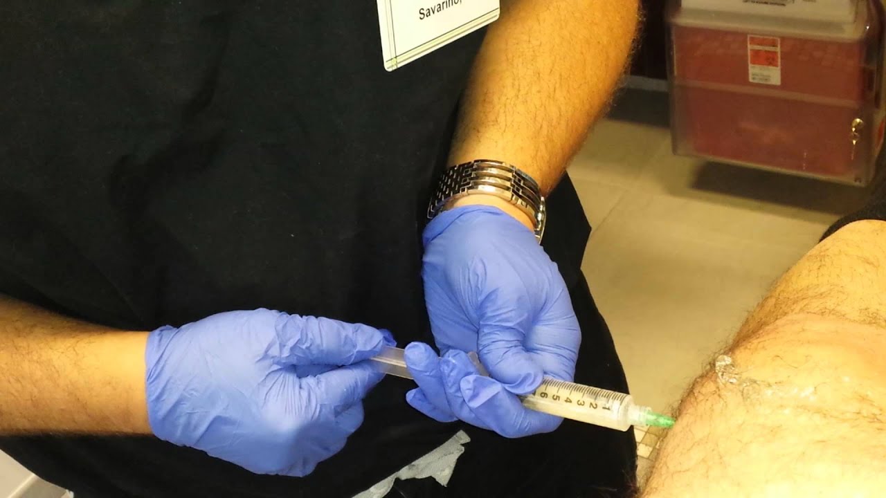 remove how fluid knee from knee 6 2014 3 drainage YouTube fluid Left remove how fluid knee from knee 6 2014 3 drainage YouTube fluid Left