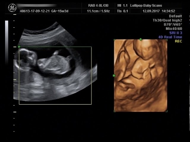 Gender scan week accuracy 15 Ultrasound gender