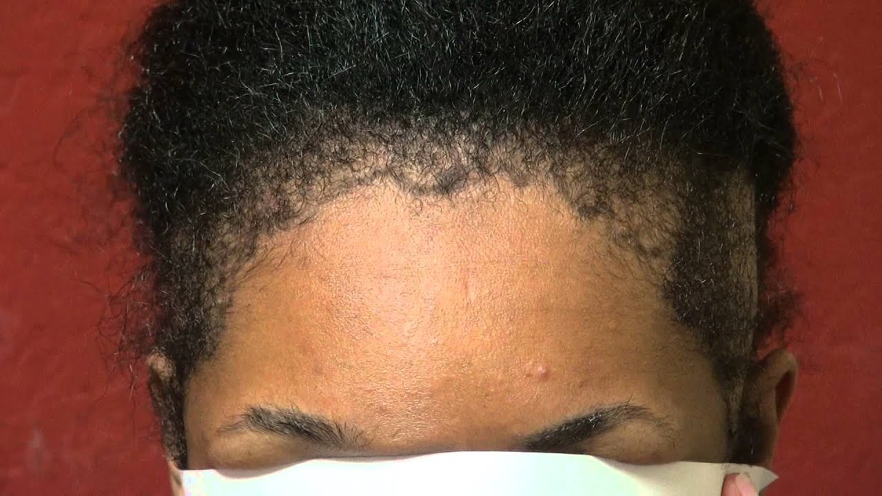 Hairstyles For Black Women With Receding Hairline : 2020 Popular