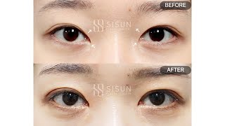 [B&amp;A] 갈고리눈, 몽고주름 제거｜절개눈매교정 재수술+축돌리기(앞트임복원+윗트임)_9개월