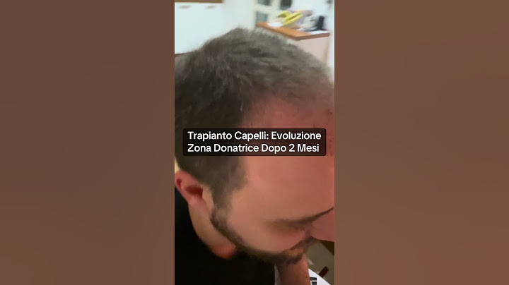 Trapianto Capelli 🇹🇷 Evoluzione Zona Donatrice Dopo 2 Mesi #trapianto #trapiantocapelli