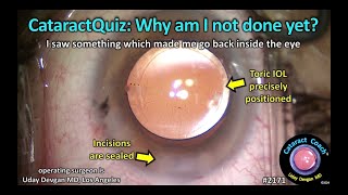 CataractCoach™ 2171: Cataract Quiz: Why am I not done yet?