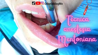 Chin Technique 💉