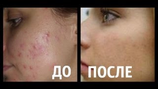 Как избавиться от ПРЫЩЕЙ БЫСТРО ?!! СУПЕР СОВЕТЫ