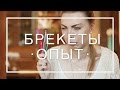 ОПЫТ | БРЕКЕТЫ: РЕШИТЬСЯ, ПОСТАВИТЬ, УХАЖИВАТЬ