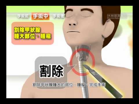 【知情同意】認識甲狀腺切除術(國語)