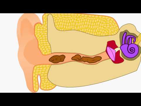 ear-wax-removal-2d-animation
