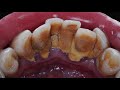 32 yo. Male&#39;s Teeth | Calculus | Karang Gigi | Dentist | Dokter Gigi Tri Putra