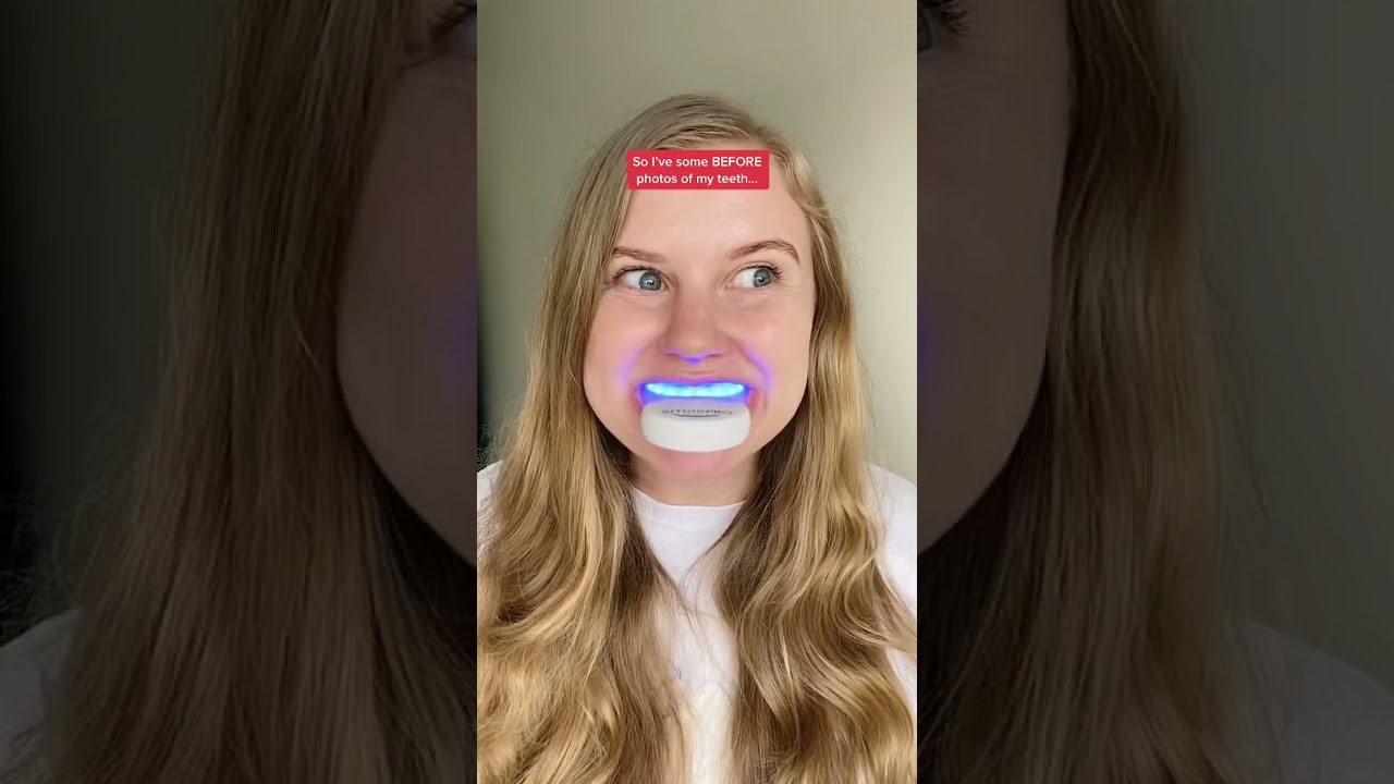 Do teeth whitening kits work? YouTube