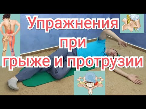 Комплекс упражнений для лечения межпозвоночной грыжи поясничного отдела позвоночника.