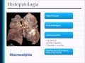 Patologa morfofuncional neoplasias pulmonares