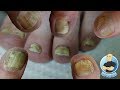 BEST TREATMENT FOR YOUR TOENAIL FUNGUS??? FOOT HEALTH MONTH 2018 #20