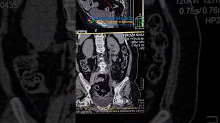 Curved MPR CT KUB #shortsfeed #shortsfeed #shortsviral #shortvideo #viral