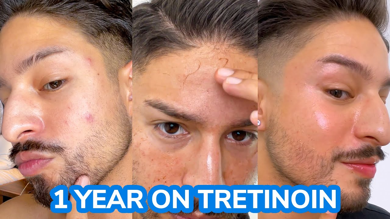 1 year Tretinoin Journey | Updated Routine + Azelaic Acid w/ Apostrophe