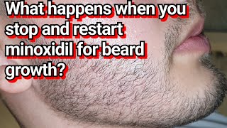 What happens when you RESTART Minoxidil for Beard Growth? - Before & After Pictures