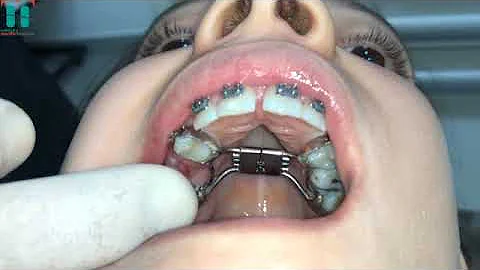 Como ajustar o aparelho expansor?