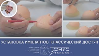 Установка имплантов. Классический доступ