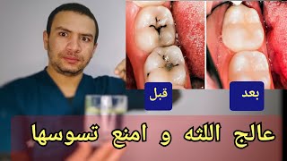 ستتعافي لثتك المريضه و سريعاً و لن تلجأ لخلع الاسنان مجددا بسبب التسوس ب ٧ طرق بسيطه