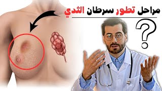 مراحل تطور سرطان الثدي، مراحل علاج سرطان الثدي، مراحل انتشار سرطان الثدي