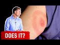 Does the Bullseye Rash Mean Lyme Disease?