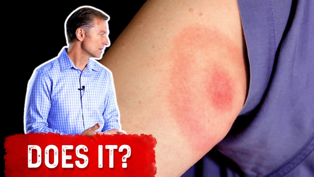 Does The Bullseye Rash Mean Lyme Disease Youtube