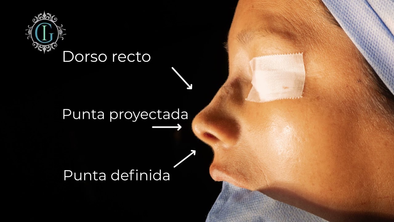 Rinoplastia Ultrasónica y Láser con el Dr. Iván Guanilo | Especialista en Rinoplastia