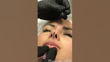 Безоперационная ринопластика носа с помощью нитей