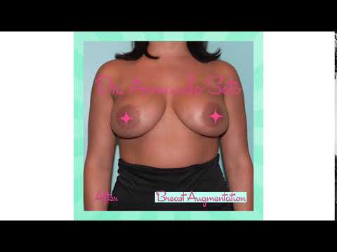 Morph - Breast Augmentation