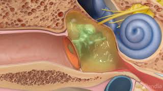 Ruptured eardrum (perforated eardrum)Treatment for eardrum rupture